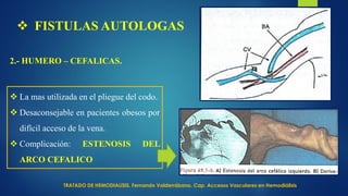  FISTULAS AUTOLOGAS
2.- HUMERO – CEFALICAS.
 La mas utilizada en el pliegue del codo.
 Desaconsejable en pacientes obesos por
difícil acceso de la vena.
 Complicación: ESTENOSIS DEL
ARCO CEFALICO
TRATADO DE HEMODIALISIS. Fernando Valderrábano. Cap. Accesos Vasculares en Hemodiálisis
 