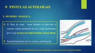  FISTULAS AUTOLOGAS
3.- HUMERO - BASILICA.
 El flujo de estas venas distales es derivado al
sistema venoso profundo por las venas perforantes,
por lo que no provoca hipertensión venosa distal.
 Superficializacion nervio cutáneo antebraquial.
TRATADO DE HEMODIALISIS. Fernando Valderrábano. Cap. Accesos Vasculares en Hemodiálisis
 