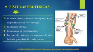 FISTULAS PROTESICAS
 Se deben usarse cuando se han agotado todas
las posibilidades de FAV autologas.
 Su duración limitada.
 Gran numero de complicaciones.
 En tipos de pacientes con esperanza de vida
limitada, gran afectación cardiovascular.
TRATADO DE HEMODIALISIS. Fernando Valderrábano. Cap. Accesos Vasculares en Hemodiálisis
 