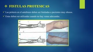  FISTULAS PROTESICAS
 Las prótesis en el antebrazo deben ser limitadas a pacientes muy obesos.
 Estas deben ser utilizadas cuando no hay venas adecuadas.
 