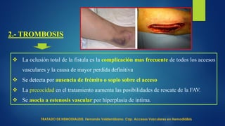 2.- TROMBOSIS
 La oclusión total de la fistula es la complicación mas frecuente de todos los accesos
vasculares y la causa de mayor perdida definitiva
 Se detecta por ausencia de frémito o soplo sobre el acceso
 La precocidad en el tratamiento aumenta las posibilidades de rescate de la FAV.
 Se asocia a estenosis vascular por hiperplasia de intima.
TRATADO DE HEMODIALISIS. Fernando Valderrábano. Cap. Accesos Vasculares en Hemodiálisis
 
