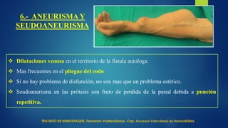 6.- ANEURISMA Y
SEUDOANEURISMA
 Dilataciones venosa en el territorio de la fistula autologa.
 Mas frecuentes en el pliegue del codo
 Si no hay problema de disfunción, no son mas que un problema estético.
 Seudoanerisma en las prótesis son fruto de perdida de la pared debida a punción
repetitiva.
TRATADO DE HEMODIALISIS. Fernando Valderrábano. Cap. Accesos Vasculares en Hemodiálisis
 