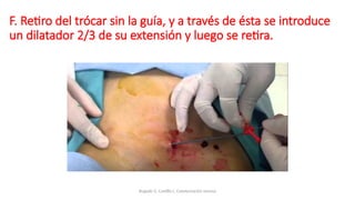 F. Retiro del trócar sin la guía, y a través de ésta se introduce
un dilatador 2/3 de su extensión y luego se retira.
Bugedo G, Castillo L. Cateterización venosa
 