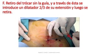 F. Retiro del trócar sin la guía, y a través de ésta se
introduce un dilatador 2/3 de su extensión y luego se
retira.
Bugedo G, Castillo L. Cateterización venosa
 