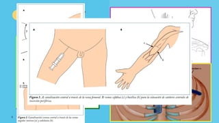6
YUGULAR
INTERNA
YUGULAR
EXTERNA
VENA
SUBCLAVIA
Cava superior
 
