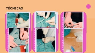 TÉCNICAS
9
1.Tras localizar el vaso a
puncionar por sus
referencias anatómicas,
se punciona con una
aguja conectada a una
jeringa con suero
heparinizado, sobre la
que se ejerce una ligera
presión negativa, hasta
que refluye sangre
2.Cuando refluye sangre,
se retira la jeringa sin
mover la aguja (rotando la
jeringa, no
traccionándola) y se
introduce a través de
laguja la guía metálica por
su parte blanda. Ésta
debe introducirse de
forma suave y con
facilidad
3. Retirar la aguja (o la
bránula) sujetando la guía
metálica y ampliar el
orificio cutáneo con
bisturí si el catéter a
insertar lo requiere, ya
que el dilatador sólo debe
utilizarse para romper la
pared del vaso
4. Introducir el dilatador
rotándolo hasta llegar a la
pared del vaso y ejercer una
presión constante desde la
parte más cercana posible al
vaso, hasta vencer la
resistencia de éste. Se retira
el dilatador manteniendo la
guía y ejerciendo compresión
en la herida cutánea para
evitar la hemorragia.
5. Deslizar el catéter venoso a
través de la guía metálica
hasta la posición deseada. No
debe introducirse el catéter
en el vaso hasta que el
extremo de la guía salga por
la conexión del catéter
Posteriormente, la guía debe
retirarse a medida que el
catéter progresa dentro de la
vena
6. Purgar las luces del
catéter eliminando las
burbujas de aire
Fijación a la piel: deben
fijarse las conexiones del
catéter para evitar
tracciones sobre su
puerta de entrada
 