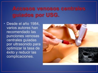 • Desde el año 1984,
varios autores han
recomendado las
punciones venosas
centrales guiadas
por ultrasonido para
optimizar la tasa de
éxito y reducir las
complicaciones.
 
