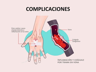 COMPLICACIONES
 