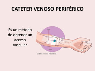 CATETER VENOSO PERIFÉRICO
Es un método
de obtener un
acceso
vascular
 