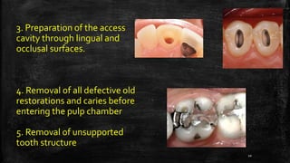 3. Preparation of the access
cavity through lingual and
occlusal surfaces.
4. Removal of all defective old
restorations and caries before
entering the pulp chamber
5. Removal of unsupported
tooth structure
10
 