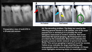 Preoperative view of tooth #19 in
a 20-year-old woman.
(A) The deroofing problem. The likely bur used by the
referring general dentist is a 56 carbide; one of the most
popular burs in dentistry,6 it is possibly the most
iatrogenic instrument in modern medicine. Red arrow
delineates the typical gouging. (B) Postoperative view
provided by the endodontist. Blue arrow indicates the
grossly excessive dentin removal of pericervical dentin
(PCD). This serious gouging is typical of round bur access.
Yellow arrow indicates the large canal flaring with
unacceptable dentin removal (blind funneling). (C) Green
circle highlights worsening lesion on mesial root ends.
103
 