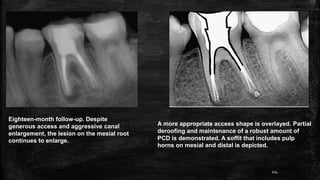 Eighteen-month follow-up. Despite
generous access and aggressive canal
enlargement, the lesion on the mesial root
continues to enlarge.
A more appropriate access shape is overlayed. Partial
deroofing and maintenance of a robust amount of
PCD is demonstrated. A soffit that includes pulp
horns on mesial and distal is depicted.
104
 