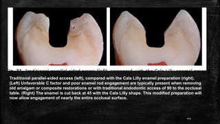 Traditional parallel-sided access (left), compared with the Cala Lilly enamel preparation (right).
(Left) Unfavorable C factor and poor enamel rod engagement are typically present when removing
old amalgam or composite restorations or with traditional endodontic access of 90 to the occlusal
table. (Right) The enamel is cut back at 45 with the Cala Lilly shape. This modified preparation will
now allow engagement of nearly the entire occlusal surface.
105
 