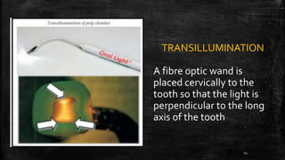 TRANSILLUMINATION
A fibre optic wand is
placed cervically to the
tooth so that the light is
perpendicular to the long
axis of the tooth
14
 