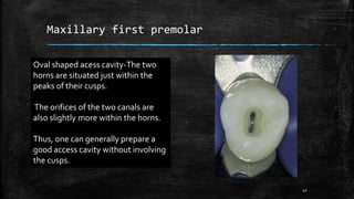 Maxillary first premolar
Oval shaped acess cavity-The two
horns are situated just within the
peaks of their cusps.
The orifices of the two canals are
also slightly more within the horns.
Thus, one can generally prepare a
good access cavity without involving
the cusps.
42
 