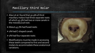 Maxillary third molar
▪ Alavi et al. found that 50.9% of third
maxillary molars had three separate roots
of which 45.5% had two or more canals in
the mesiobuccal root.
About 45.7% had fused roots
2% had C-shaped canals
2% had four separate roots
▪ Modifications must be made in accessing
these teeth compared to first and second
molars to accommodate these anatomical
variations.
50
 