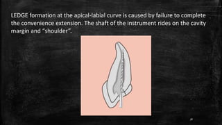 LEDGE formation at the apical-labial curve is caused by failure to complete
the convenience extension. The shaft of the instrument rides on the cavity
margin and “shoulder”.
78
 