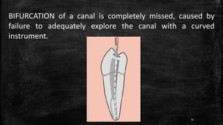 BIFURCATION of a canal is completely missed, caused by
failure to adequately explore the canal with a curved
instrument.
79
 