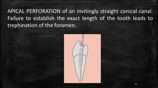 APICAL PERFORATION of an invitingly straight conical canal.
Failure to establish the exact length of the tooth leads to
trephination of the foramen.
APICAL PERFORATION of an invitingly straight conical canal. Failure to establish the exact length of the tooth leads to trephination of the foramen.
80
 