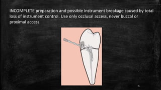INCOMPLETE preparation and possible instrument breakage caused by total
loss of instrument control. Use only occlusal access, never buccal or
proximal access.
81
 