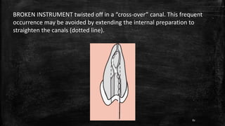 BROKEN INSTRUMENT twisted off in a “cross-over” canal. This frequent
occurrence may be avoided by extending the internal preparation to
straighten the canals (dotted line).
82
 