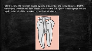 PERFORATION into furcation caused by using a longer bur and failing to realise that the
narrow pulp chamber had been passed. Measure the bur against the radiograph and the
depth to the pulpal floor marked on the shaft with Dycal
83
 