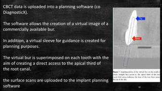 CBCT data is uploaded into a planning software (co
DiagnosticX).
The software allows the creation of a virtual image of a
commercially available bur.
In addition, a virtual sleeve for guidance is created for
planning purposes.
The virtual bur is superimposed on each tooth with the
aim of creating a direct access to the apical third of
the root canal.
the surface scans are uploaded to the implant planning
software 95
 