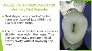 access cavity preparation in upper and lower teeth. pdf | PDF