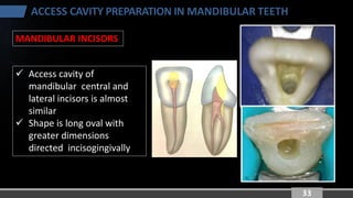 Principles of Endodontic Access Cavity Preparation: Mandibular Teeth | PDF