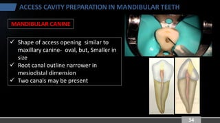 Principles of Endodontic Access Cavity Preparation: Mandibular Teeth | PDF