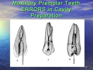 Maxillary Premolar Teeth
  ERRORS in Cavity
       Preparation




                           27
 