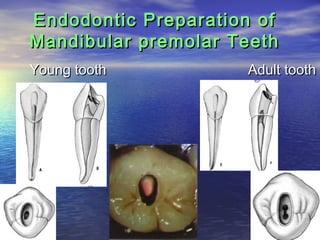 Endodontic Preparation of
Mandibular premolar Teeth
Young tooth          Adult tooth




                            30
 