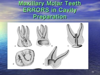 Maxillary Molar Teeth
 ERRORS in Cavity
     Preparation




                        43
 