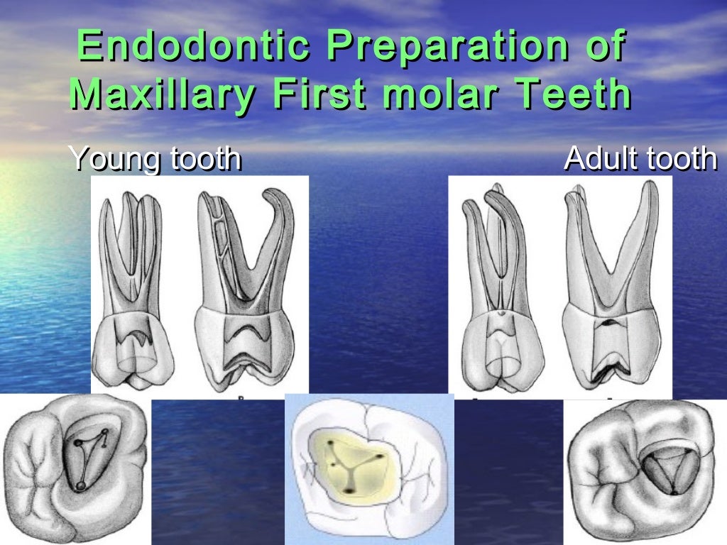 Access cavity preparation