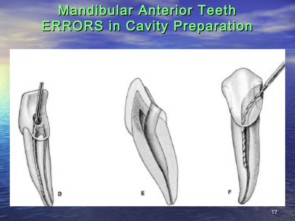 Access cavity preparation