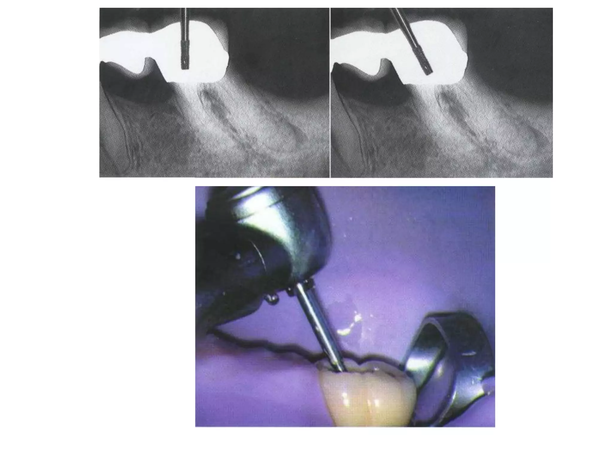 Access cavity preparation | PDF