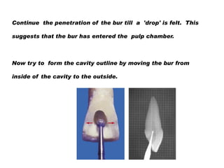 Continue the penetration of the bur till a 'drop' is felt. This
suggests that the bur has entered the pulp chamber.

Now try to form the cavity outline by moving the bur from
inside of the cavity to the outside.

 