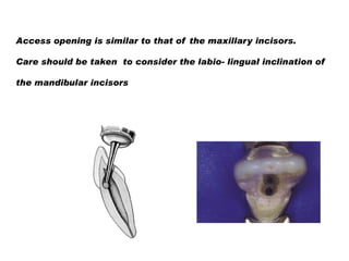 Access opening is similar to that of the maxillary incisors.
Care should be taken to consider the labio- lingual inclination of
the mandibular incisors

 