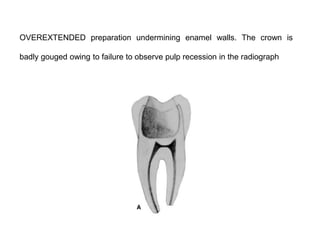 OVEREXTENDED preparation undermining enamel walls. The crown is
badly gouged owing to failure to observe pulp recession in the radiograph

 