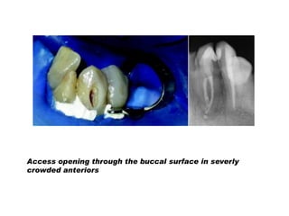 Access opening through the buccal surface in severly
crowded anteriors

 