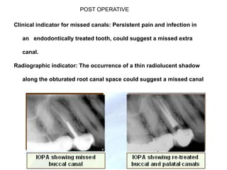 POST OPERATIVE
Clinical indicator for missed canals: Persistent pain and infection in
an endodontically treated tooth, could suggest a missed extra

canal.
Radiographic indicator: The occurrence of a thin radiolucent shadow
along the obturated root canal space could suggest a missed canal

 