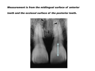 Measurement is from the midlingual surface of anterior

teeth and the occlusal surface of the posterior teeth.

 