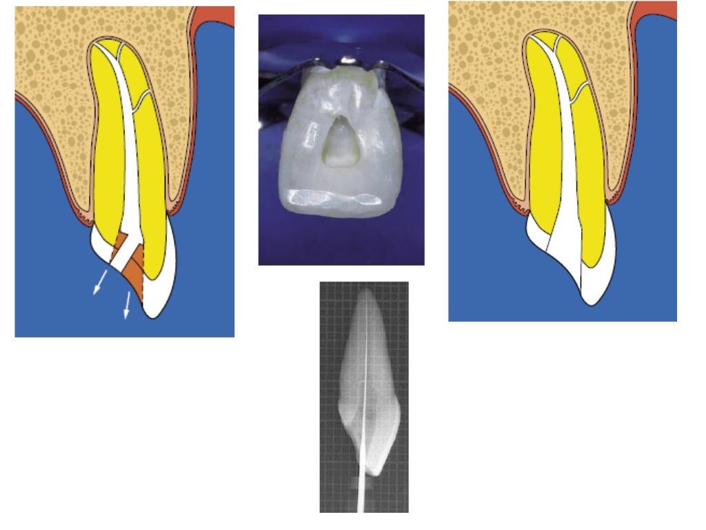Access cavity preparation
