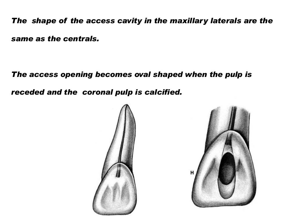 Access cavity preparation