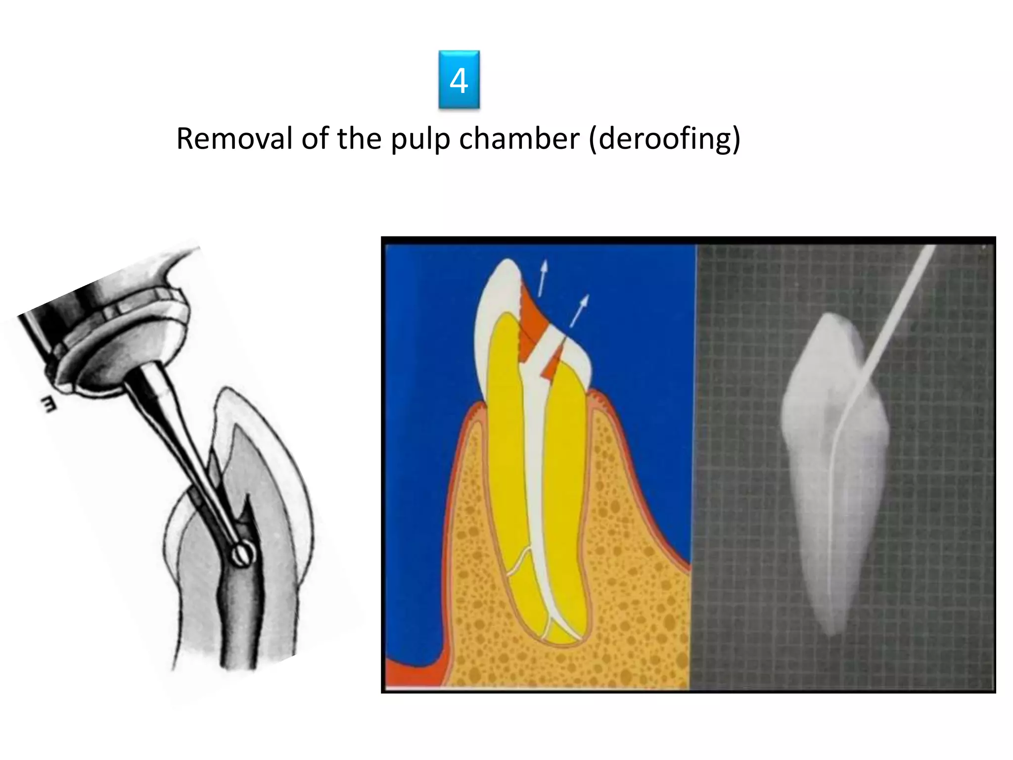 Removal of the pulp chamber (deroofing)
4
 