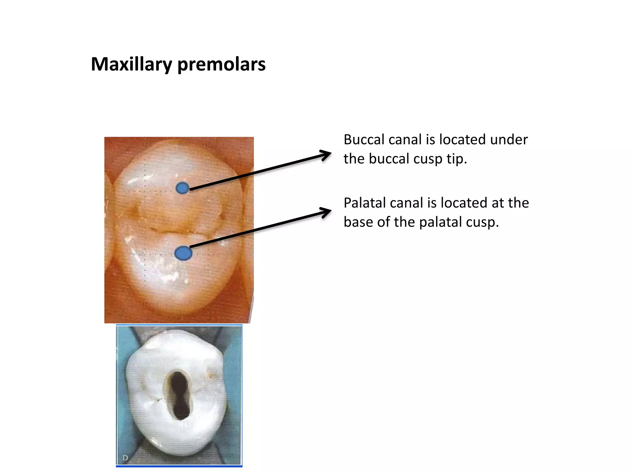 Maxillary premolars
Buccal canal is located under
the buccal cusp tip.
Palatal canal is located at the
base of the palatal cusp.
 