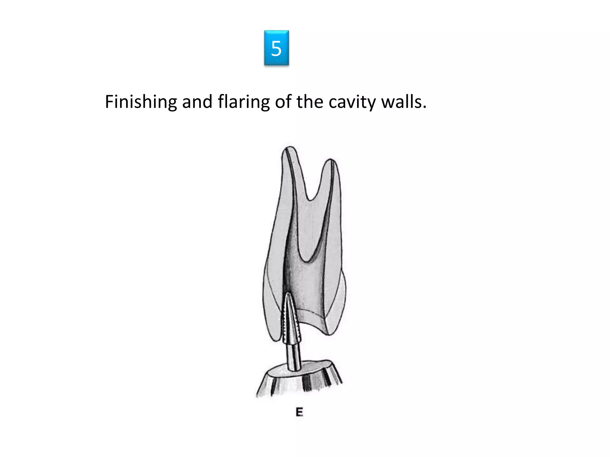 Finishing and flaring of the cavity walls.
5
 