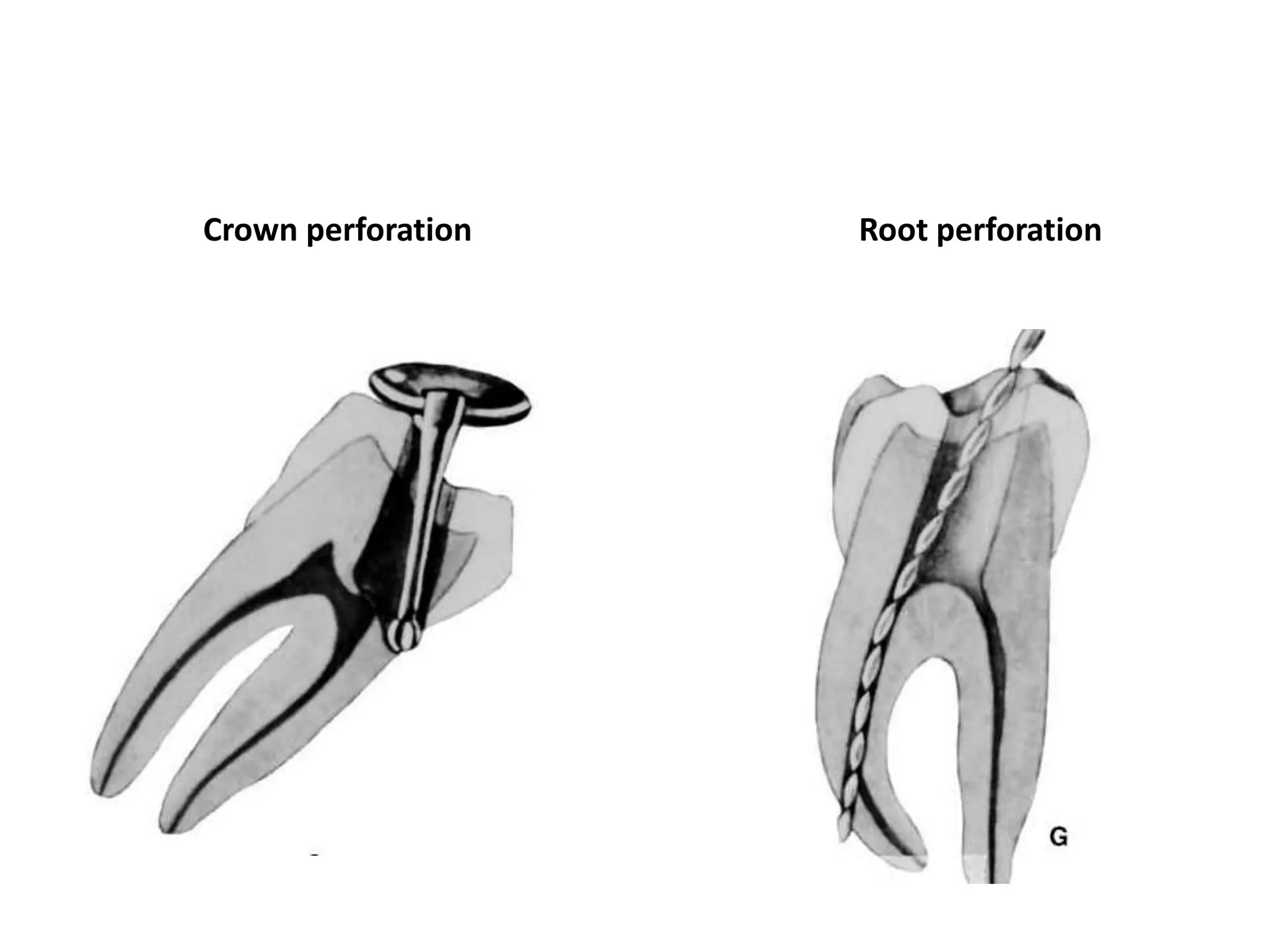 Crown perforation Root perforation
 