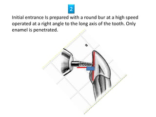 Initial entrance Is prepared with a round bur at a high speed
operated at a right angle to the long axis of the tooth. Only
enamel is penetrated.
2
 