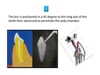 The bur is positioned in a 45 degree to the long axis of the
tooth then advanced to penetrate the pulp chamber.
3
 